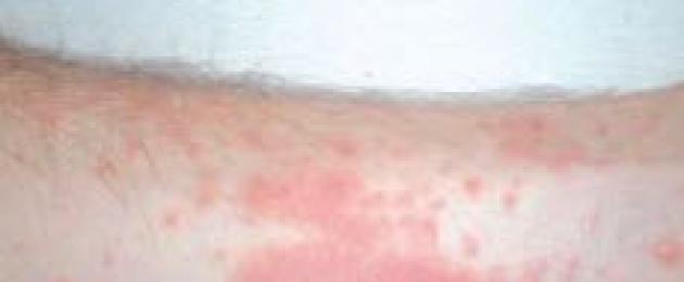 التهاب الجلد المعدية على الساقين والذراعين.  أسباب التهاب الجلد في الأطراف العلوية والسفلية