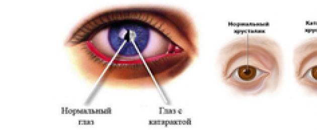 Операция катаракты - единственный вариант лечения катаракты. Цена операции по удалению катаракты