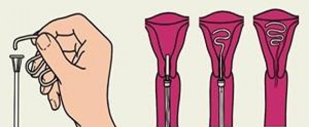 La prima mestruazione dopo l'introduzione dello IUD.  Come cambia la natura delle mestruazioni dopo l'installazione di una spirale non ormonale?  Possibili conseguenze dell'uso di un dispositivo intrauterino per la contraccezione