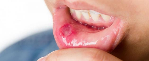 Красные или белые болячки на губах. Незаживающие раны на губах