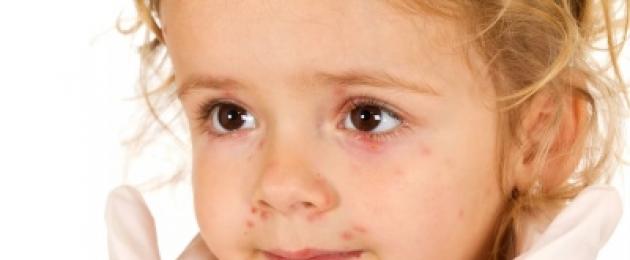Красные волдыри на теле у ребенка чешутся. Как лечить водянистые пузырьки на коже? Появление новообразований систематически