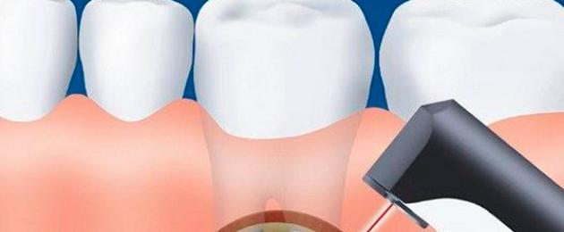 ما هو استئصال قمة الجذر؟  مؤشرات لاستئصال قمة جذر السن - مراحل العملية والمضاعفات المحتملة ما هو الاستئصال في طب الأسنان