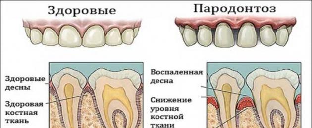Пародонтоз зубов лечение в домашних. Рецепты средств для полоскания