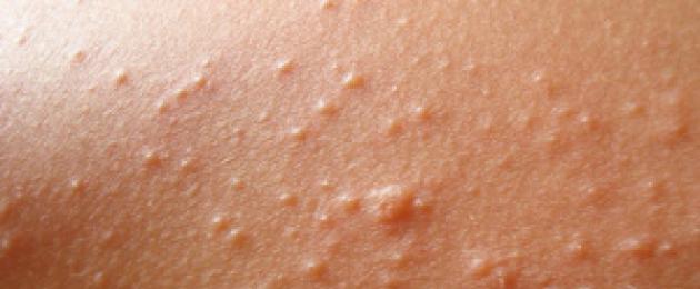 Eruzione cutanea negli adulti, cause e foto.  Malattie della pelle comuni nei bambini: foto e descrizione, cause e trattamento