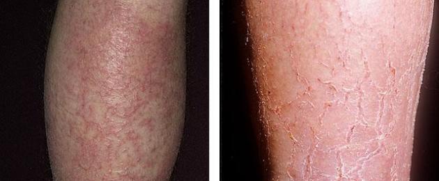 Olio di cocco ed eczema: cosa dicono gli esperti sui trattamenti alternativi per la pelle.  L'eczema si può curare!  Oli essenziali