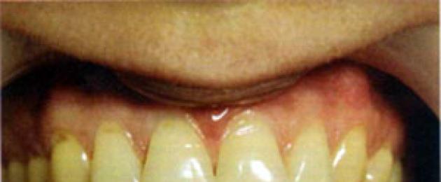 عيب في أنسجة الأسنان الصلبة وفقًا للتصنيف الدولي للأمراض 10. عيب على شكل إسفين