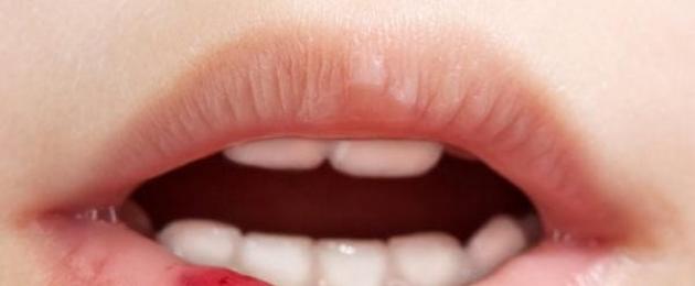 Опухла верхняя губа – в чем причина? Опухла губа: причины, лечение отека нижней и верхней губы. 