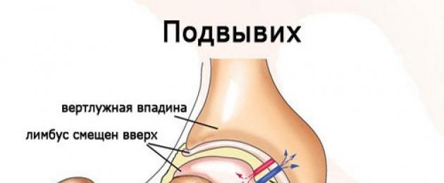 Lussazione congenita dell'articolazione dell'anca in un neonato.  Trattamento della displasia negli adulti
