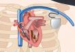 Cardiologia: metodi moderni di trattamento dell'aritmia in Germania