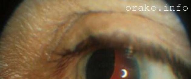 Рачьи глаза. Симптомы рака века и его лечение