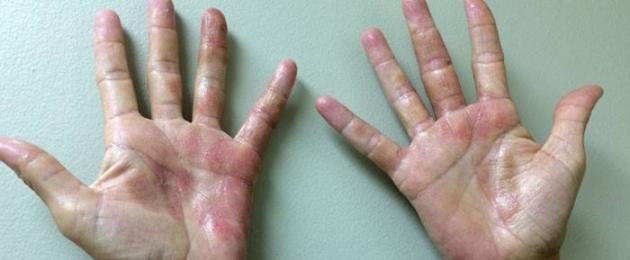 Come curare la dermatite da contatto sulle mani.  Perché si verifica la dermatite e come si manifesta?  I pericoli derivanti dall'applicazione di cosmetici sulle aree danneggiate