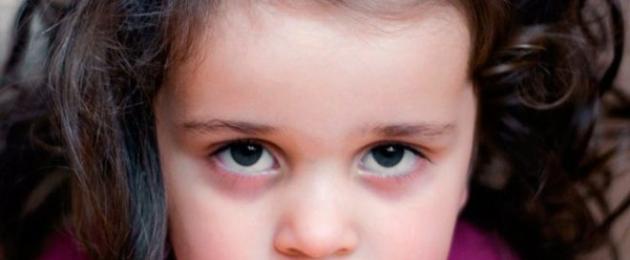 Синюшность под глазами у ребенка. Почему возникают синяки под глазами у ребенка