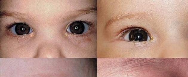 Закисает глазик у ребенка 3 года. Закисают глаза у ребенка, чем и как лечить? Что делать, если закисают глаза у ребенка: чем лечить, чем капать