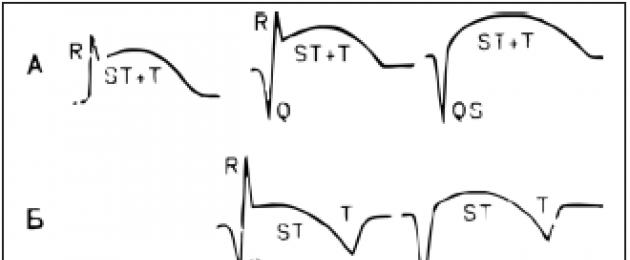 Spostamento del segmento ST.  Elettrocardiogramma del cuore