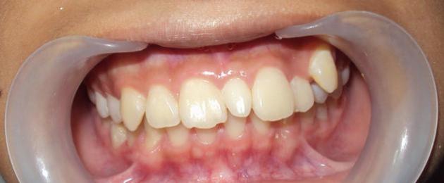 Гипердонтия — когда зубов во рту много. Полиодонтия