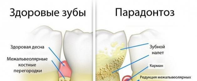 Как и чем лечат парадонтозе. Парадонтоз: как спасти зубы и какие лекарства помогают
