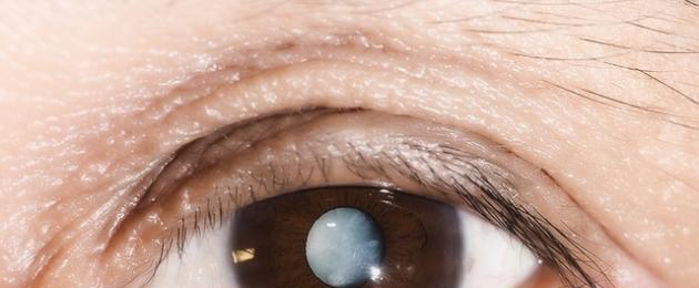 Sulla pupilla del bambino apparve una macchia bianca.  Macchia gialla sul bianco dell'occhio in un bambino: cosa significa, come viene trattata e come prevenirla