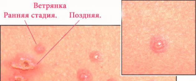 Sintomi della varicella in un bambino di 5 anni.  Come appaiono i primi segni della varicella nei bambini: sintomi con una foto, trattamento e prevenzione del vaiolo