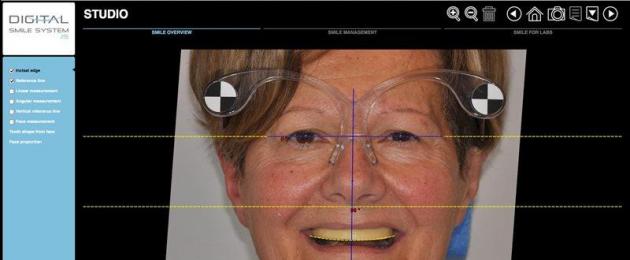 Creazione di una protesi tutto-ponte nell'applicazione Digital Smile System.  Simulazione computerizzata di un sorriso