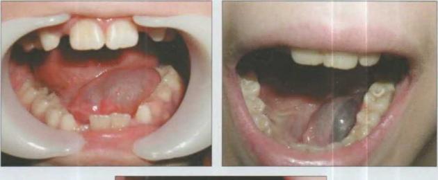 Стоматит, волдыри и болячки под языком: схема лечения в зависимости от причины возникновения язв. Почему появляются волдыри на языке у ребенка и как их правильно лечить