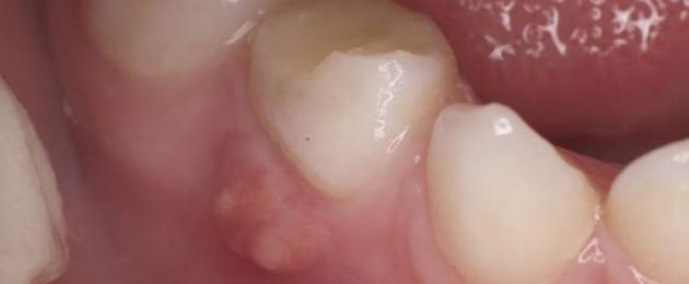 Зубной флюс — симптомы и способы лечения. Как быстро убрать флюс на десне? Лечение в домашних условиях