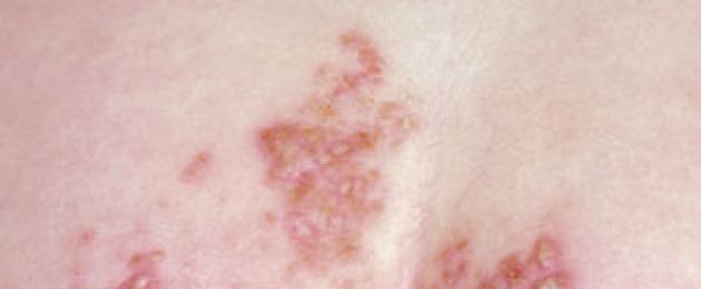 Dermatite da pannolino da candida.  Candidosi (dermatite da pannolino)