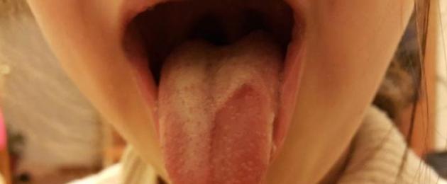 Malattie del cavo orale: classificazione, sintomi, principi generali di terapia.  Patologie del cavo orale nell'adulto