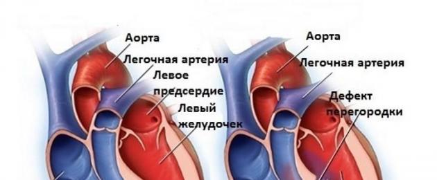 Difetti cardiaci congeniti: difetto del setto interatriale.  Difetto del setto interatriale