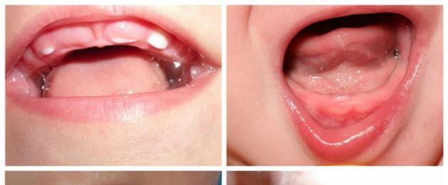 Когда меняются молочные зубы на постоянные. Когда прорезываются и выпадают молочные зубы: схема и сроки смены прикуса у детей по возрастам