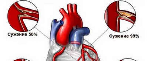 Ischemia cardiaca.  I segni comuni di ischemia cardiaca sono