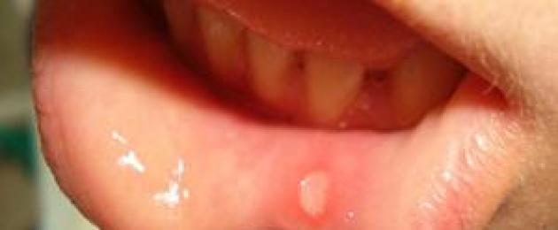 علاج التهاب الفم عند الأطفال أقل من سنة واحدة.  التهاب الفم وعلاجه عند الأطفال حديثي الولادة والأطفال أقل من سنة المصابين بالحمى