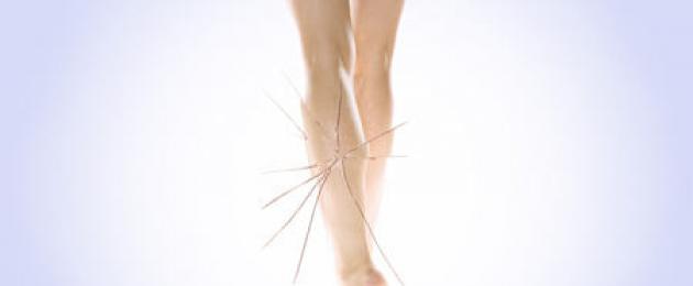 Как удалить венозные сеточки на ногах. Сосудистая сетка на ногах