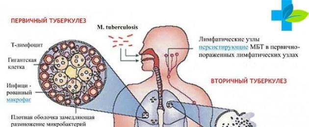 Симптомы туберкулеза на ранней стадии. Борьба с туберкулезом на ранней стадии