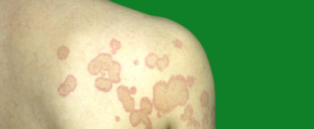 Симптомы и лечение дерматомикоза, фото заболевания. Что такое дерматомикоз гладкой кожи и как его лечить