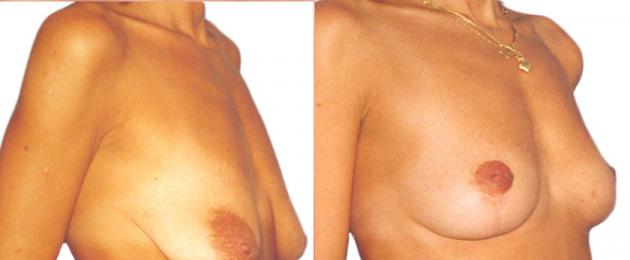 Операция по подтяжке грудных. Подтяжка грудных желез, подтяжка груди, мастопексия