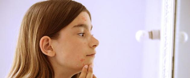 كيفية علاج التهاب الغدة الدهنية في الوجه.  قواعد للبشرة الدهنية