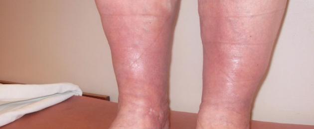 Варикозная экзема на ногах - причины и симптомы, лечение мазями и народными средствами. Варикозная экзема на ногах, как осложнение флебологических заболеваний
