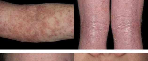 C'è la dermatite atopica.  Dermatite atopica: cos'è (foto), come trattare?  Farmaci e dieta
