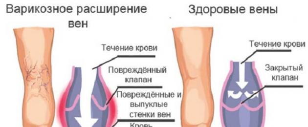 Симптомы варикозного расширения вен (варикоза) на ногах. Что такое варикозное расширение вен на ногах: фото, симптомы болезни и тактика терапии