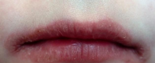 Покраснение внутренней стороны губы. Что такое хейлит и как лечить каждую из его разновидностей