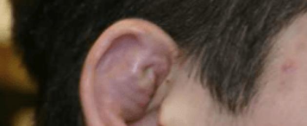 Lesioni meccaniche dell'orecchio.  Cosa devo fare se il mio orecchio è danneggiato o ferito?  Cause, segni, sintomi, diagnosi, metodi di trattamento