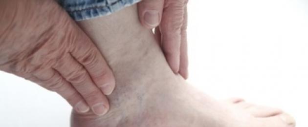 Карпальный туннельный синдром стопы. Синдром расколотой голени и туннельные синдромы ноги