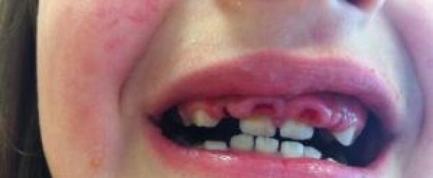 Adentia parziale (parziale assenza di denti).  Come si chiama l'assenza totale o parziale di denti?