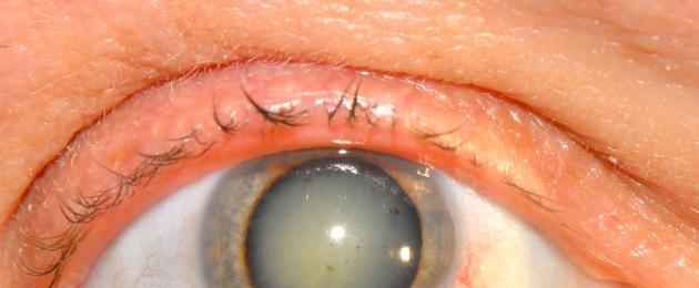 Что такое факоэмульсификация катаракты с имплантацией ИОЛ и как происходит лечение? Интраокулярные линзы (ИОЛ) – искусственные хрусталики Операция катаракты методом факоэмульсификации. 
