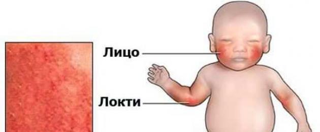 Macchie rosse sul collo di un bambino.  Cosa significano le macchie rosse e rosa sulla fronte o sul corpo di un neonato?