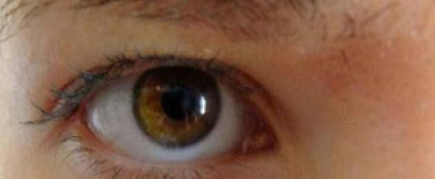 Пожелтели белки глаз что делать. Пожелтел белок глаз: причины, симптомы, диагностика, лечение, последствия и рекомендации врачей