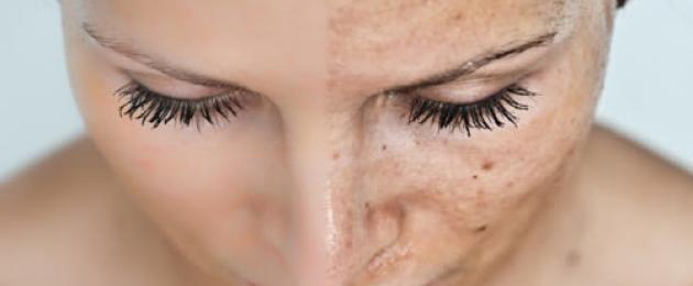 Come appaiono le macchie pigmentate?  Disturbi della pigmentazione della pelle: cause, trattamento, foto.  Galleria fotografica di vari tipi di pigmentazione