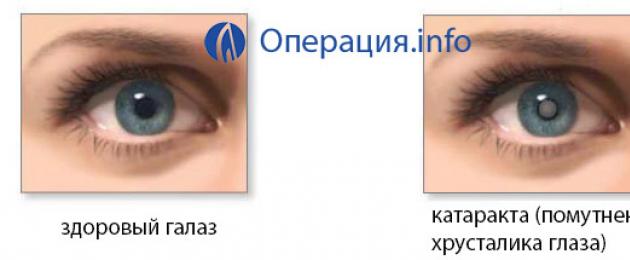 Покраснение глаза после замены хрусталика при катаракте. Осложнения хирургии катаракты