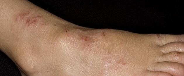 Аллергический дерматоз между ног. Варикозный дерматит: причины, симптомы и стадии заболевания, лечение
