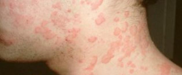 Аллергия — симптомы и лечение. Аллергия: виды, симптомы и лечение